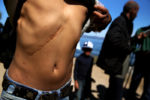 Yettea, a Syrian refugee, shows his scars after arriving on the shore near Skala Sykaminias on the island of Lesbos, Greece. He is fleeing Syria where he had been shot twice. Yettea arrived on a rubber dinghy with a group of men from Damascus, a city in Syria badly damaged by the civil war. He and the other men said they feared the repressive government or the Islamic State extremists would harm their families back home.